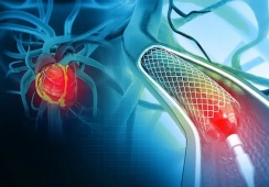 Sau can thiệp đặt stent mạch vành: Bao lâu có thể làm việc trở lại?