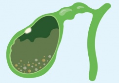 Có polyp túi mật và sỏi bùn túi mật cần cẩn trọng gì?