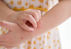Giải pháp thảo dược cho trẻ bị nổi mề đay