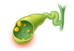 Polyp túi mật 14mm có nguy hiểm không?