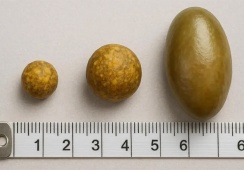 Sỏi mật 9,6mm có nguy hiểm không?