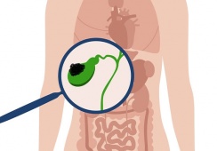 Đa polyp túi mật 9x8mm nên xử trí thế nào?