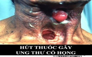 Cảnh báo bằng hình ảnh tránh được tử vong do thuốc lá