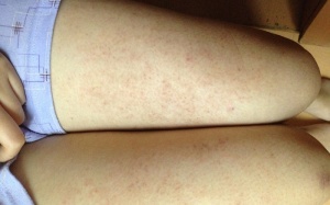 Mùa đông dễ mắc viêm nang lông