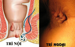 Bệnh trĩ - Biểu hiện, nguyên nhân và cách khắc phục
