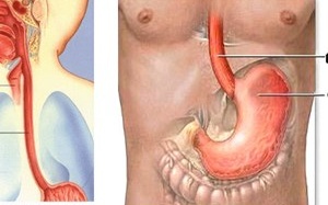 Trào ngược dạ dày thực quản dễ dẫn đến ung thư