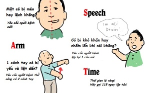 Quy tắc vàng để cứu sống người đột quỵ