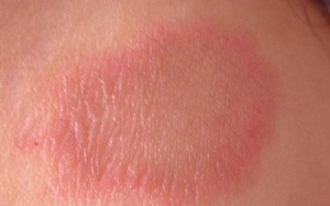 Điều trị 'tróc da' do vảy phấn trắng