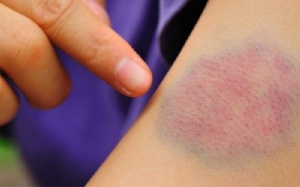 Da hay bị bầm tím là bệnh gì?