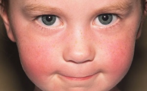 Trẻ bị mẩn ngứa khắp người do đâu?