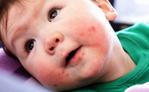 Hà Nội có 50 trường hợp mắc bệnh tay chân miệng