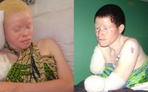 Tanzania: Mua chân tay người bạch tạng làm bùa may mắn