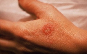 Từ bệnh da lan ra bệnh tim, đột quỵ