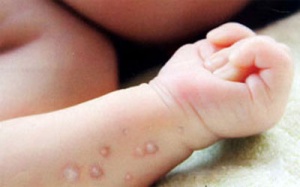 TP.HCM: Xuất hiện ổ dịch thủy đậu