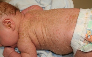 Đông y trị bệnh vảy cá mùa hanh khô 