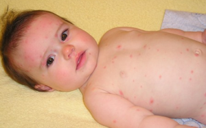 Chăm sóc trẻ mắc thủy đậu như thế nào?