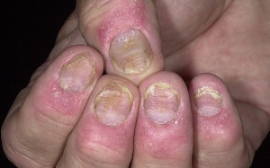 Làm sao điều trị hết nấm móng tay?