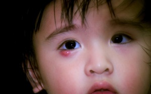 Điều trị lẹo mắt dứt điểm như thế nào?