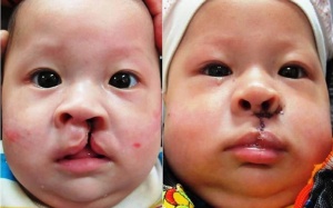 Sứt môi, hở hàm ếch có di truyền không?