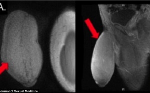 Phẫu thuật cắt bớt vì súng to như đại bác!