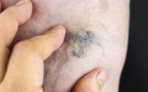 Thiết bị mới điều trị giãn tĩnh mạch