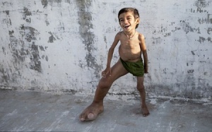 Bàn chân khủng không rõ nguyên nhân