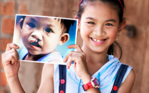 Phẫu thuật miễn phí trẻ hở hàm ếch vào tháng 3