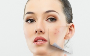 Sạch mụn, tươi tắn đón 8/3