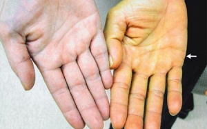 Vàng da, vàng mắt có phải bệnh viêm gan?