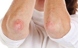 Người bị bệnh vảy nến nên ăn uống như thế nào?