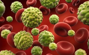 Loại bỏ máu đông điều trị ung thư thận