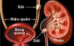 Tán sỏi bằng thực phẩm có lợi