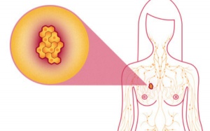 Infographic: Dấu hiệu nhận biết bệnh ung thư vú