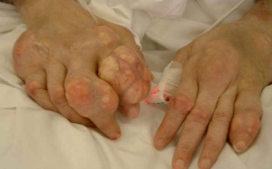 Hạn chế uống rượu để phòng ngừa bệnh gout