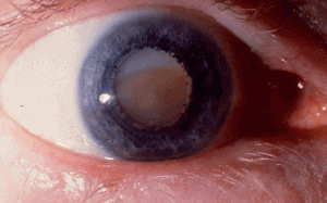 Nguyên nhân nào gây đục thủy tinh thể?