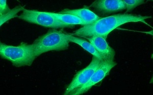 Vaccine hứa hẹn phòng chống ung thư da ác tính tái phát