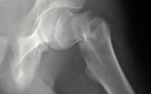 Ăn gà bỏ da, lãng phí 'thuốc' phòng bệnh xương khớp