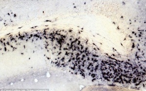 Bổ sung arginase có ngừa được bệnh Alzheimer?