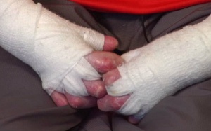 Cậu bé 14 tuổi mắc bệnh da mỏng như cánh bướm