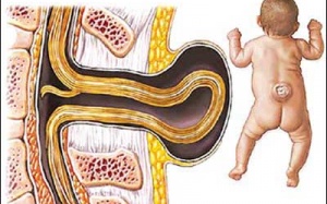 Bệnh thoát vị màng não tủy ở trẻ em có nguy hiểm?