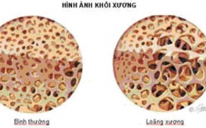Loãng xương ngay khi còn trẻ