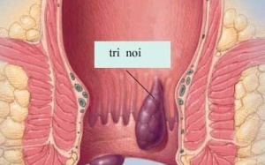 Bệnh trĩ - đau này biết kể cùng ai