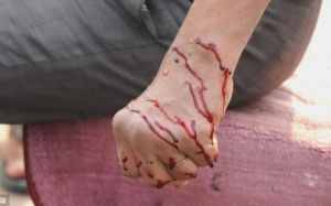 Ấn Độ: Dùng dao lam rạch người để... trị bách bệnh