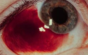 Chảy máu mắt - Tai nạn không hiếm gặp