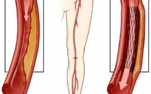 Viêm tắc động mạch chi - bệnh do lối sống