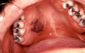 Rùng rợn những hình ảnh về lây nhiễm khi oral sex