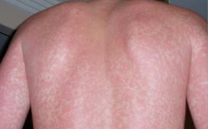 Sốt xuất huyết có nguy cơ lan rộng