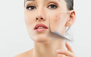 Tránh mụn chẳng xấu mặt nào...