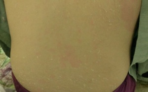 Bị lột da loang lổ vì tắm trắng tại nhà