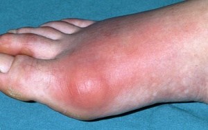 Gần vợ nhiều, bệnh gút nặng hơn?